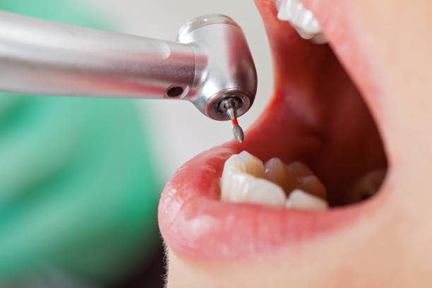 Best Emergency Dentist for Lost Fillings or Crowns in Badieville, LA